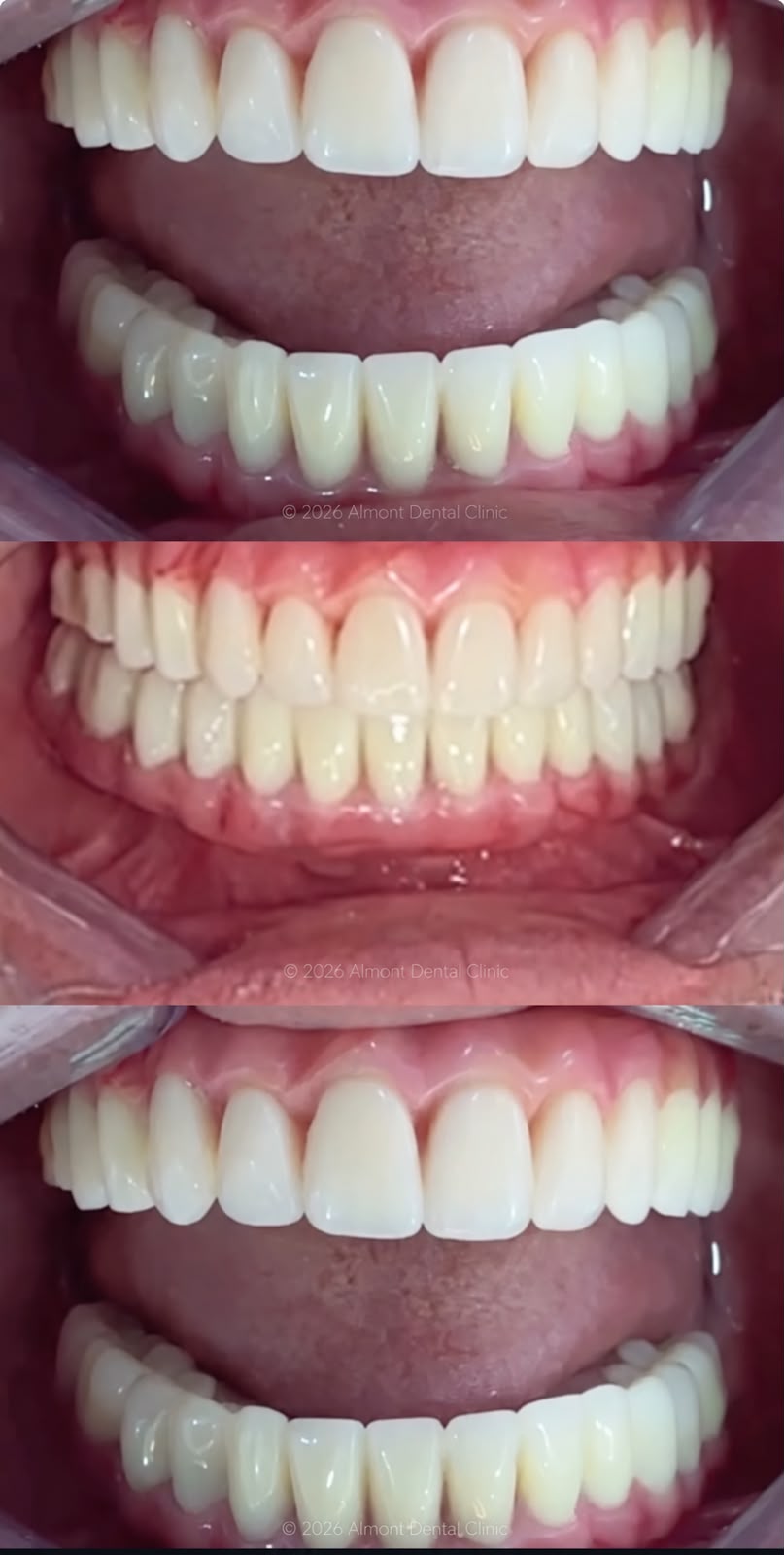 Full upper and lower arch restorations