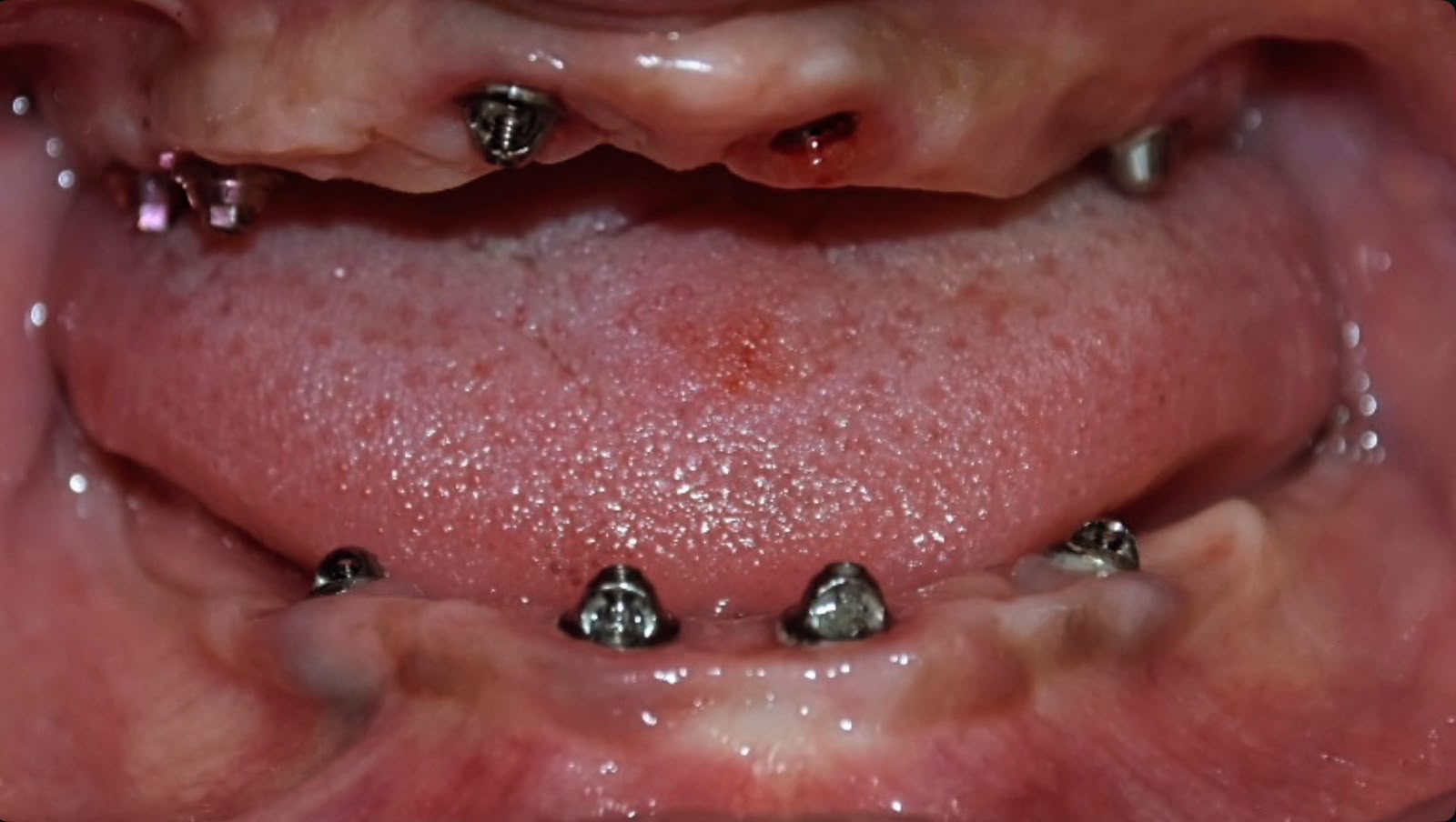 Implant sites and gum healing before restoration