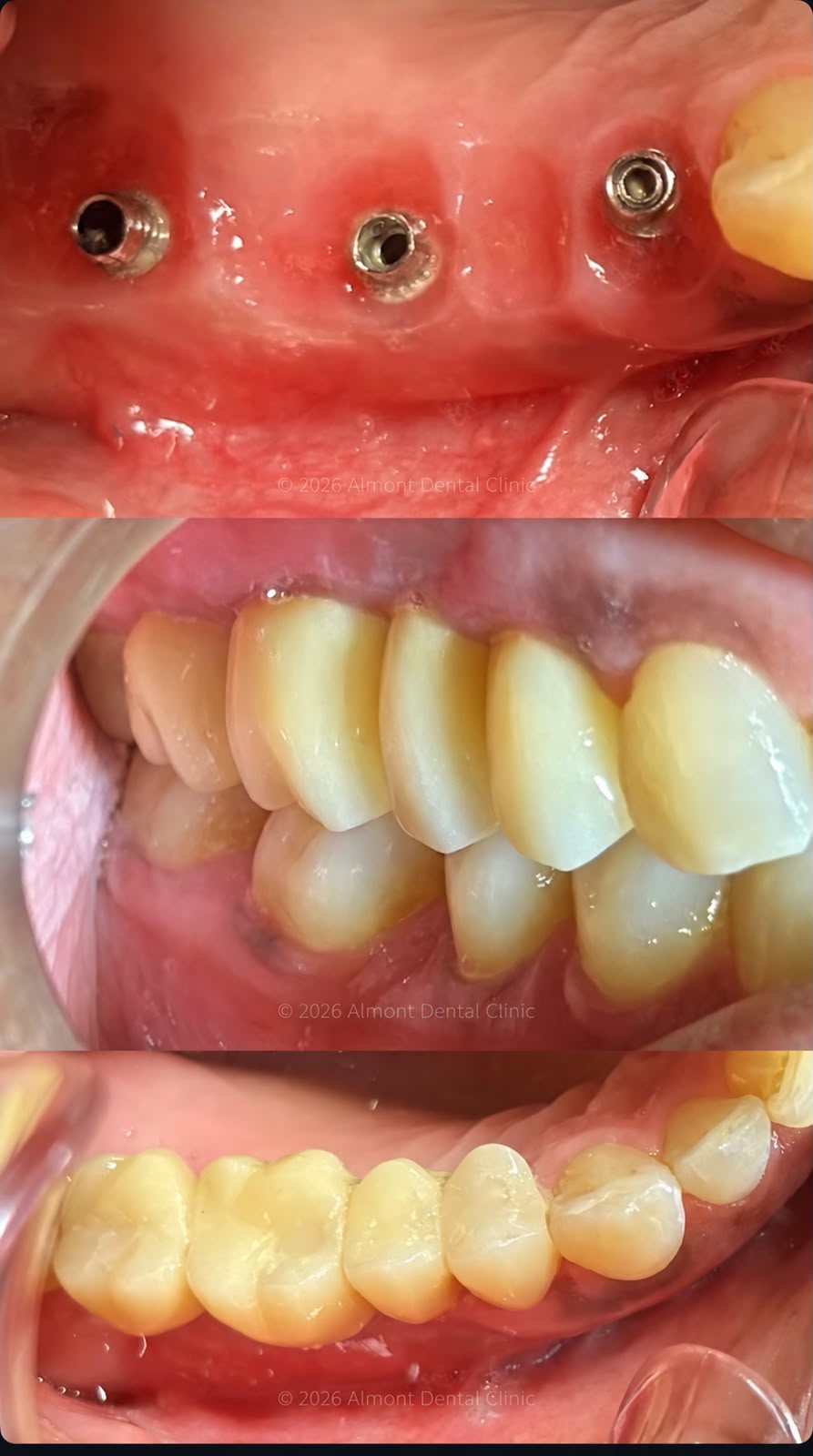Clinical photographs of an implant-supported restoration