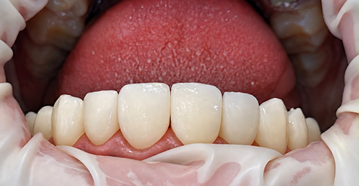Custom porcelain veneers after smile design treatment