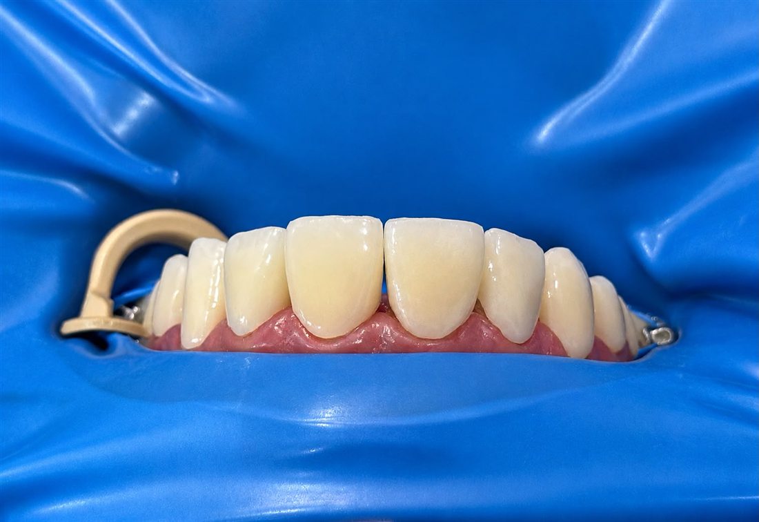 Composite veneers smile design